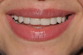 Faccette dentali in ceramica: Consulenza estetica  professionale - Faccette Dentali Estetiche