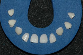 Definizione delle faccette moderne in ceramica - Faccette Dentali Estetiche