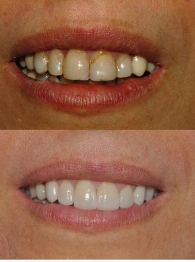 Quanto costano le faccette dentali estetiche - Faccette Dentali Estetiche