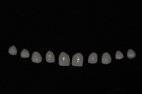 faccette estetiche in ceramica - Faccette Dentali Estetiche