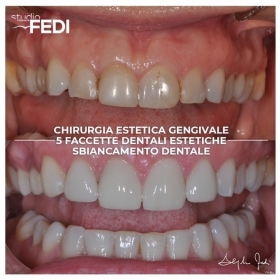 5 faccette dentali estetiche - Faccette Dentali Estetiche