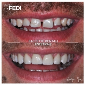 5 faccette dentali estetiche per chiusura diastemi multipli - Faccette Dentali Estetiche