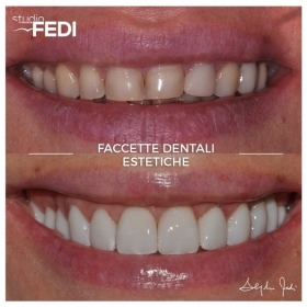 un nuovo sorriso con dieci faccette dentali in ceramica - Faccette Dentali Estetiche