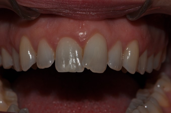  - Faccette Dentali Estetiche